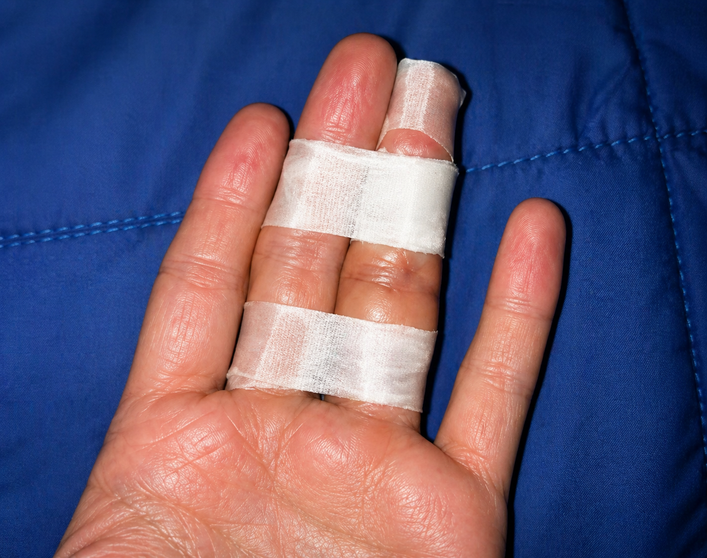 Recovering from a Finger Fracture